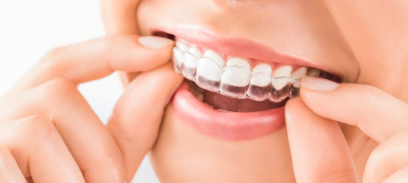 So funktionieren transparente Aligner: Eine schrittweise Übersicht