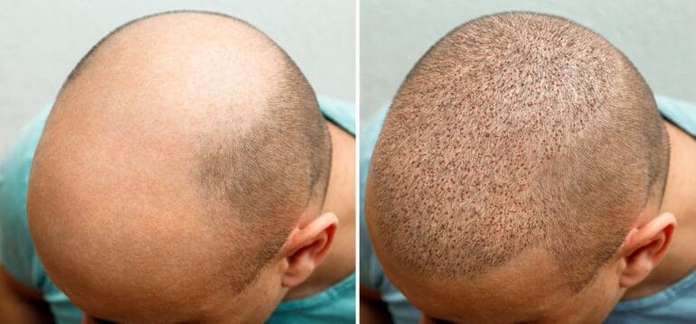 Erreichen Sie natürlich aussehendes Haar mit fortschrittlichen Haartransplantationstechniken