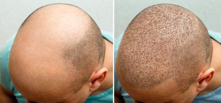 Erreichen Sie natürlich aussehendes Haar mit fortschrittlichen Haartransplantationstechniken